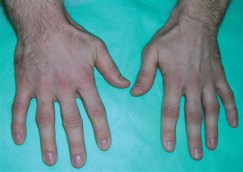 Dedos De La Mano En Enfermedades Reumáticas Dedos De La Mano