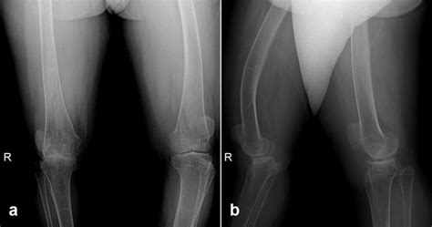 Anteroposterior A And Lateral B Knee Radiographs Demonstrate