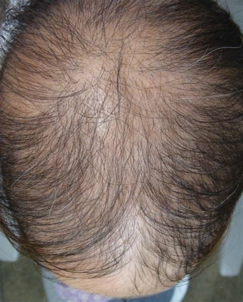 Alopecia Areata Causes Treatments Breakthroughs 2020 Guide