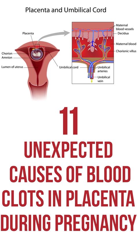 11 Causes Of Blood Clots In Placenta During Pregnancy