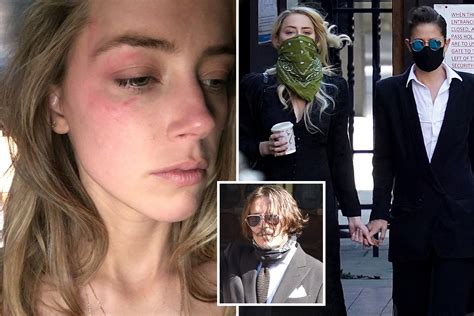 Shock New Pic Shows Amber Heards Bruised Face After Johnny Depp Hurled Phone At Her In Row