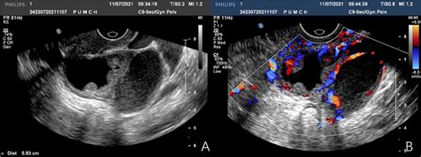 Transvaginal Ultrasound Imaging Of The Left Adnexal Mass A