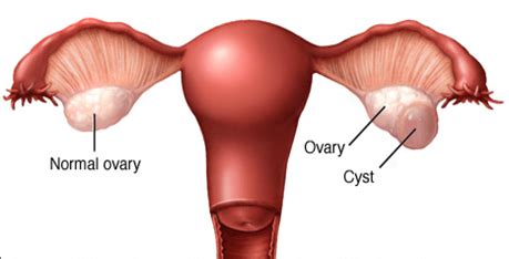 Dermoids, a term now used almost always interchangeably with teratomas, are tumors derived from more than one germ layer, frequently all three. Ovarian Cysts - Philippe de Rosnay