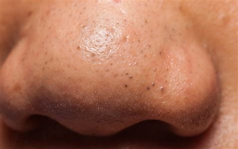 Blackheads On Nose Causes Remedies And Prevention Tips The Derm Spot