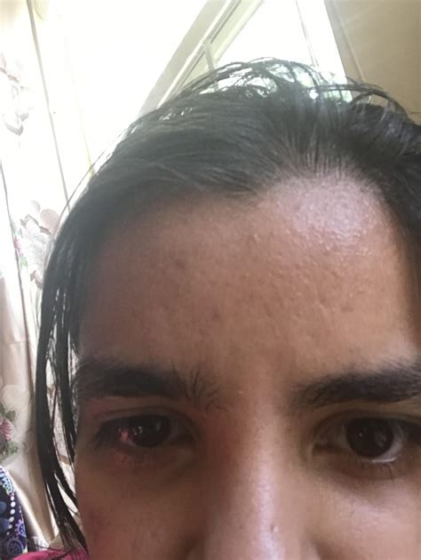 Forehead Texture Texture Acne What To Do Rskincareaddiction