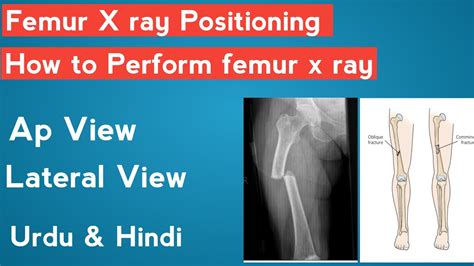 Femur X Ray Positioning How To Perform Femur X Ray Youtube