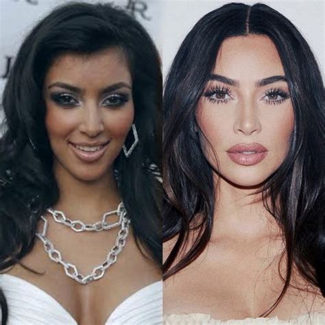 Kim Kardashian Before And After Celebrity Surgery Celebrity Plastic