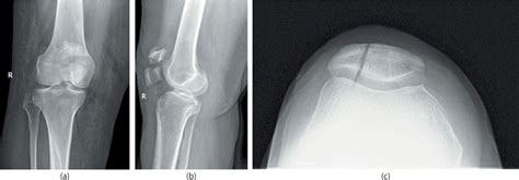 Patellar Fractures Musculoskeletal Key