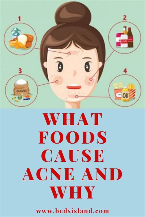 What Foods Cause Acne And Why Acne Causing Foods Food That Causes