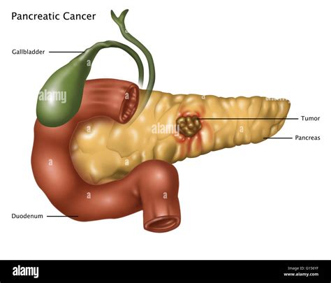 Illustration Of Pancreatic Cancer At Center Of The Pancreas Is A Tumor