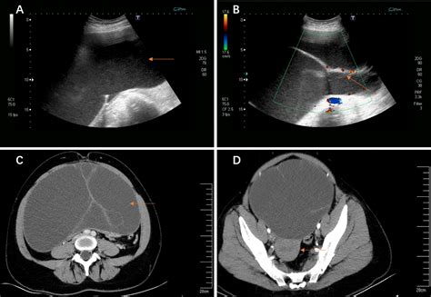 Frontiers Giant Ovarian Cysts Treated By Single Port Laparoscopic