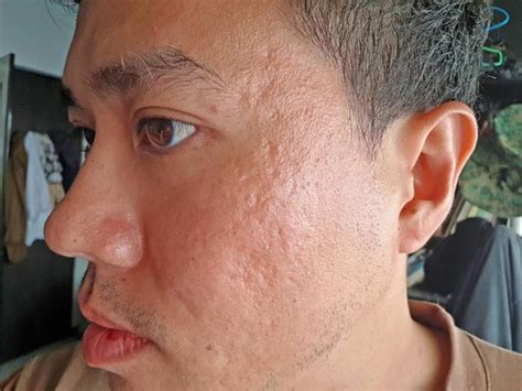 Acne Scar Treatment Co2 Laser Infini Results After A Couple Sessions