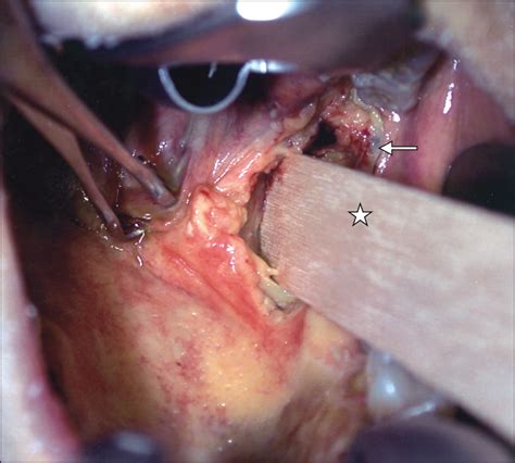 Transoral Lateral Oropharyngectomy For Squamous Cell Carcinoma Of The