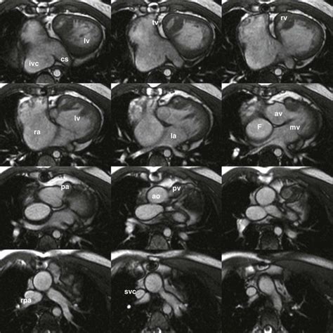 Cardiovascular Anatomy And Segmental Approach To Imaging Of Congenital