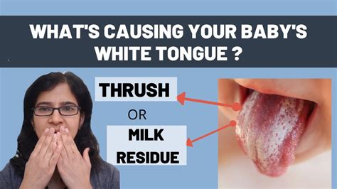 Thrush Vs Milk Tongue Atelier Yuwa Ciao Jp