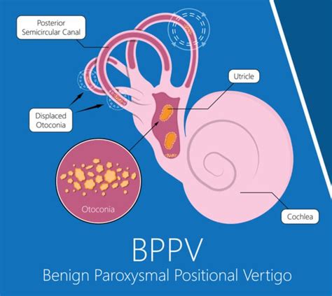 Benign Paroxysmal Positional Vertigo Bppv Symptoms And Causes