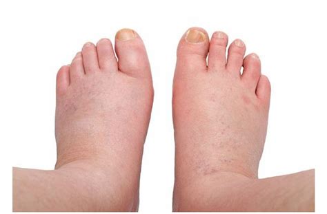 Water Retention Causes Treatment And Home Remedies For Swelling In