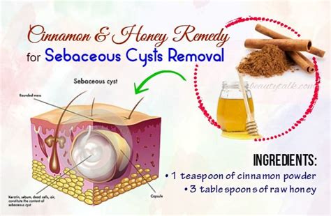 15 Remedies On How To Get Rid Of Sebaceous Cysts Naturally Cysts