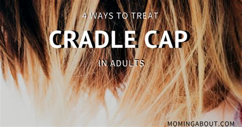 Moming About 4 Ways To Treat Adult Cradle Cap Scalp Psoriasis