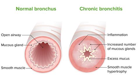 Bronchitis Causes Symptoms Diagnosis Prevention