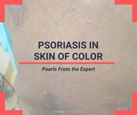 Psoriasis In Skin Of Color Pearls From The Expert Next Steps In