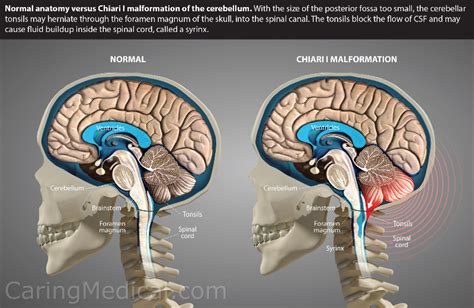 Compression Of The Brainstem Atlantoaxial Instability And Atlas