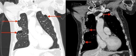 Subpleural Cystic Change In A Patient With Multiple Rib Exostoses Thorax