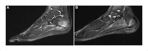 Magnetic Resonance Image Of Foot A Complete Rupture Of Plantar