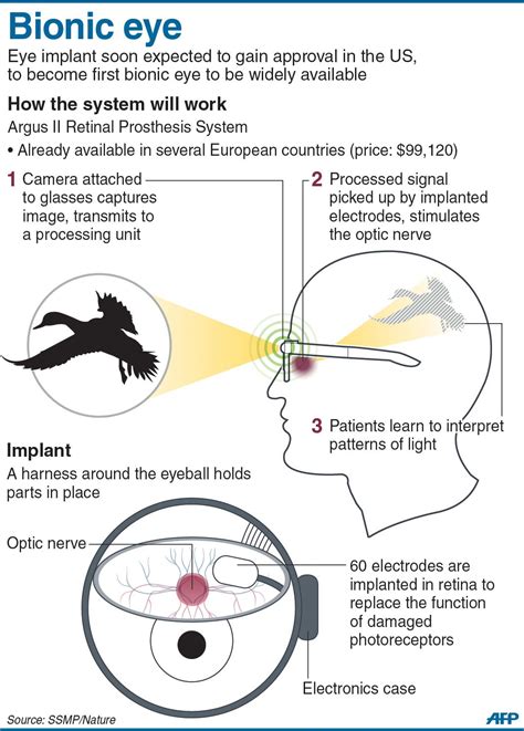 Graphic Outlining How A Bionic Eye System Works The First Retinal