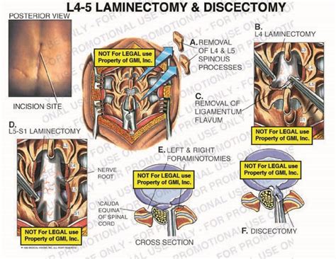 L4 5 Laminectomy And Discectomy 97130e19a Generic Medical Legal Exhibits A Division Of Mvi