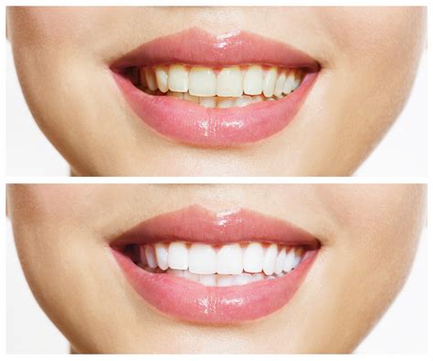 How To Whiten Your Teeth Naturally At Home Quickly And Instantly