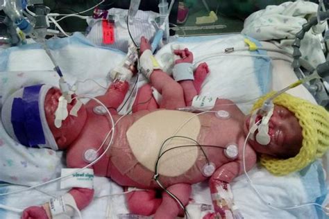 Conjoined Twins Doing Great After Surviving 10 Hour Separation Surgery