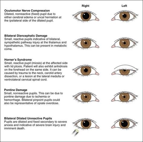 Optometry Optometry School Medical Mnemonics