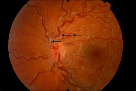 Central Retinal Vein Occlusion In A Young Woman Using The Contraceptive