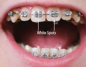 Maybe you would like to learn more about one of these? White Spots on Teeth During Orthodontic Treatment