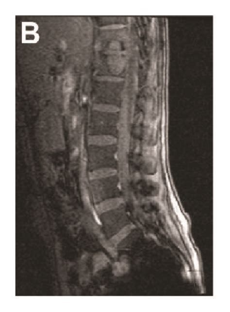 A Radiograph Of A 25 Year Old Woman Showing T11 And T12 Vertebral