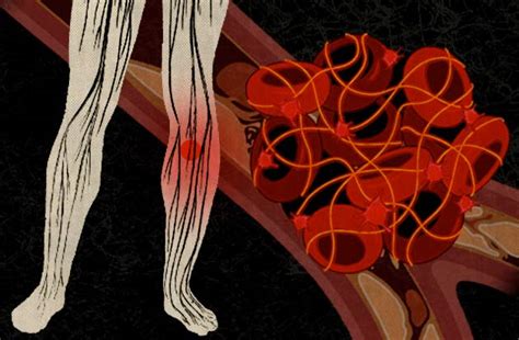 This blockage often manifests itself in the form of limping. Blood clots: What cancer patients need to know