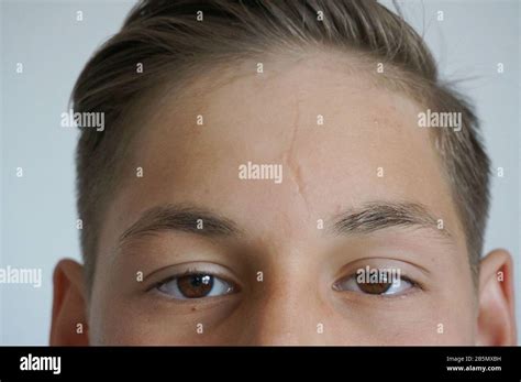 Teenagers Acne Hi Res Stock Photography And Images Alamy