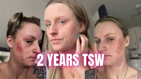 Two Years Topical Steroid Withdrawal Tsw Update Youtube