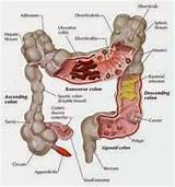 Pictures of Constant Intestinal Gas
