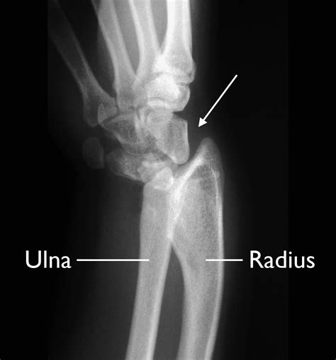 Upper Extremity Limb Length Discrepancy Orthoinfo Aaos