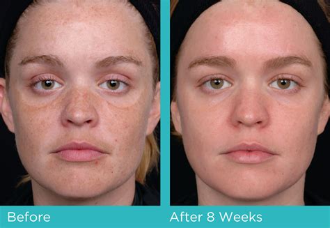 Lansdowne Facial Aesthetics | Our Treatments | Obagi Nu-Derm | Before ...