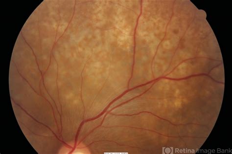 Choroidal Metastasis From Breast Cancer Retina Image Bank