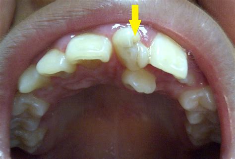 Zona Ortodoncia Dientes Supernumerarios