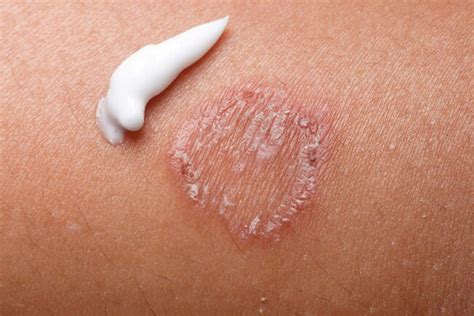 10 Most Common Types Of Skin Rashes Daily Health Valley