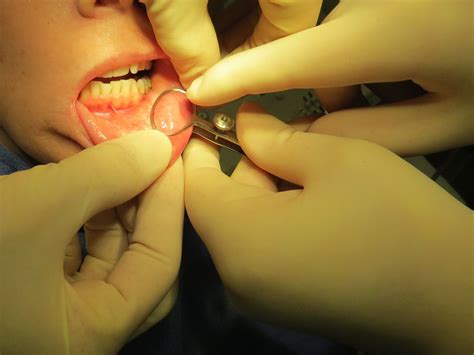 Lip Biopsy For Sjogren S Syndrome Minor Salivary Gland Biopsy Using Chalazion Clamp Iowa