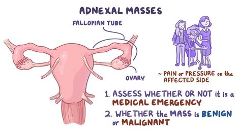 Adnexal Mass What Is It Causes Treatment And More Osmosis