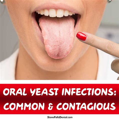 Oral Yeast Infections Common And Contagious