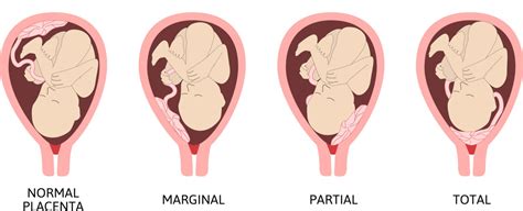 In many women diagnosed with placenta previa early in their pregnancies, the placenta previa resolves. What is Placenta Previa - WomenH.com