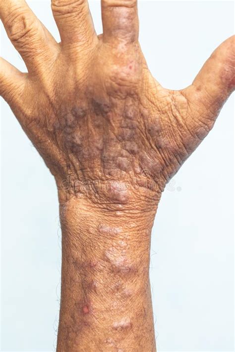 A Physical Of Atopic Dermatitis Ad Also Known As Atopic Eczema Stock
